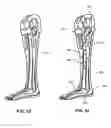 Fig. 15 - MODULAR PROSTHETIC SOCKETS AND METHODS FOR MAKING SAME