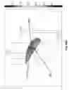 Fig. 77 - Shock wave applicator with movable electrode