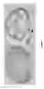 Fig. 09 - Conditional angiopoietin-1/angiopoietin-2 double knock-out mice with defective ocular drainage system