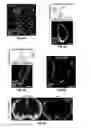 Fig. 08 - Methods for evaluating brain-wide paravascular pathway for waste clearance function and methods for treating neurodegenerative disorders based thereon