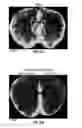 Fig. 112 - Methods for evaluating brain-wide paravascular pathway for waste clearance function and methods for treating neurodegenerative disorders based thereon