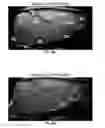 Fig. 44 - Methods for evaluating brain-wide paravascular pathway for waste clearance function and methods for treating neurodegenerative disorders based thereon
