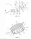 Fig. 09 - Dialysis implant and methods of use