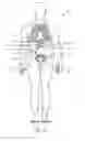 Fig. 10 - Dialysis implant and methods of use