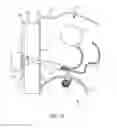 Fig. 12 - Dialysis implant and methods of use