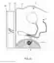 Fig. 16 - Dialysis implant and methods of use