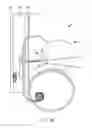 Fig. 20 - Dialysis implant and methods of use