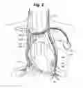 Fig. 03 - System and method to modulate phrenic nerve to prevent sleep apnea