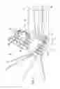 Fig. 09 - Endoscope with Pupil Expander