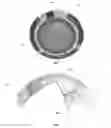 Fig. 01 - Ophthalmic devices with stabilization features