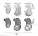 Fig. 08 - Computational flow dynamics based method for estimating thromboembolic risk in patients with myocardial infarction
