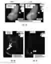 Fig. 10 - Computational flow dynamics based method for estimating thromboembolic risk in patients with myocardial infarction
