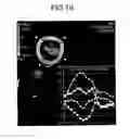 Fig. 16 - Apparatus and method for tracking contour of moving object, and apparatus and method for analyzing myocardial motion