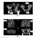Fig. 03 - User-guided shape morphing in bone segmentation for medical imaging