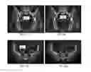Fig. 04 - User-guided shape morphing in bone segmentation for medical imaging