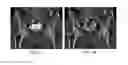 Fig. 05 - User-guided shape morphing in bone segmentation for medical imaging