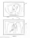 Fig. 03 - Trachea marking