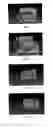 Fig. 05 - METHOD AND SYSTEM FOR AUTOMATICALLY ALIGNING MODELS OF AN UPPER JAW AND A LOWER JAW