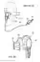 Fig. 03 - Earpiece positioning and retaining