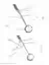 Fig. 03 - Substantially rigid and stable endoluminal surgical suite for treating a gastrointestinal lesion