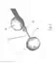 Fig. 08 - Substantially rigid and stable endoluminal surgical suite for treating a gastrointestinal lesion