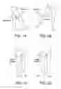 Fig. 02 - Method and apparatus for distracting a joint