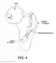 Fig. 05 - Method and apparatus for distracting a joint