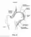 Fig. 07 - Method and apparatus for distracting a joint