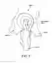 Fig. 08 - Method and apparatus for distracting a joint