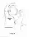 Fig. 09 - Method and apparatus for distracting a joint