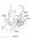 Fig. 10 - Method and apparatus for distracting a joint