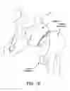 Fig. 11 - Method and apparatus for distracting a joint