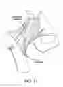 Fig. 12 - Method and apparatus for distracting a joint