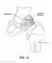 Fig. 13 - Method and apparatus for distracting a joint