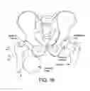 Fig. 17 - Method and apparatus for distracting a joint