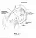 Fig. 20 - Method and apparatus for distracting a joint