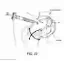 Fig. 22 - Method and apparatus for distracting a joint