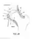 Fig. 29 - Method and apparatus for distracting a joint