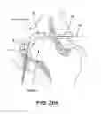 Fig. 30 - Method and apparatus for distracting a joint