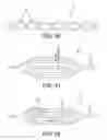 Fig. 40 - Method and apparatus for distracting a joint