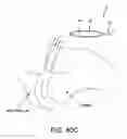 Fig. 44 - Method and apparatus for distracting a joint