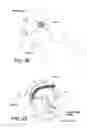 Fig. 47 - Method and apparatus for distracting a joint