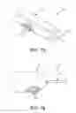 Fig. 51 - Method and apparatus for distracting a joint