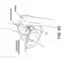 Fig. 56 - Method and apparatus for distracting a joint