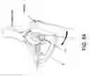 Fig. 57 - Method and apparatus for distracting a joint