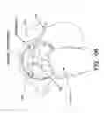 Fig. 79 - Method and apparatus for distracting a joint