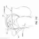 Fig. 85 - Method and apparatus for distracting a joint