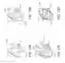 Fig. 09 - Mechanical retraction via tethering for lung volume reduction