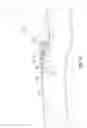 Fig. 08 - METHODS AND SYSTEMS FOR ADVANCING AND ANCHORING SUTURE IN TISSUE