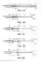 Fig. 02 - Methods and Devices for Controlling the Size of Emphysematous Bullae